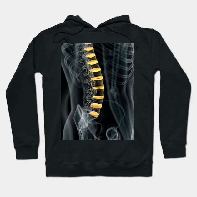 Human spinal intervertebral discs (F011/7098) Hoodie by SciencePhoto